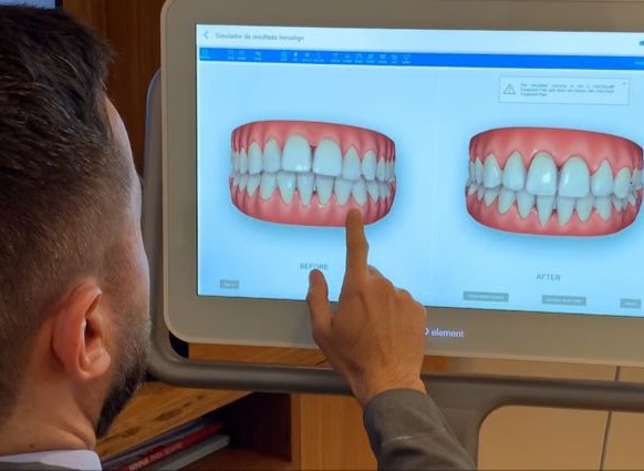 Invisalign - Maior previsibilidade