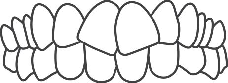 Invisalign - Dentes desalinhados